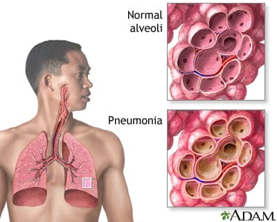 pneumonia adalah