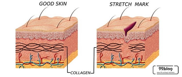 cara menghilangkan stretch mark
